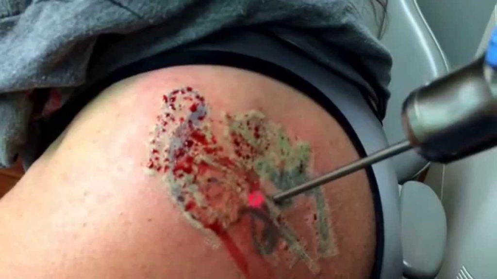 laser-tattoo-removal-guide
