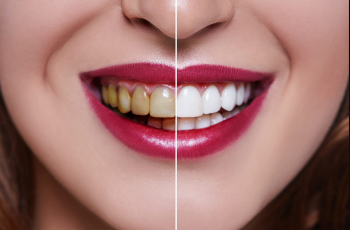 Teeth Veneers Gold Coast